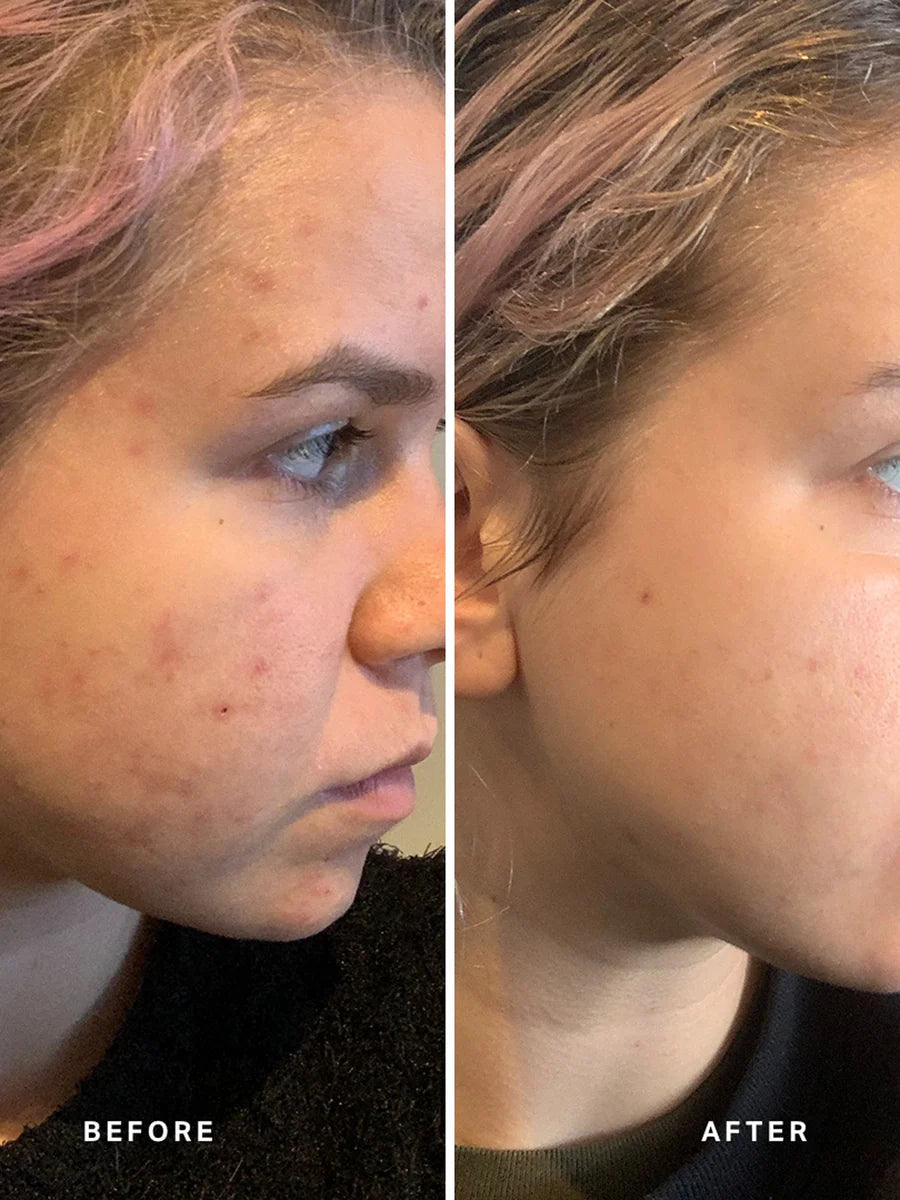 Instant Action BHA Blemish Treatment 20 ml